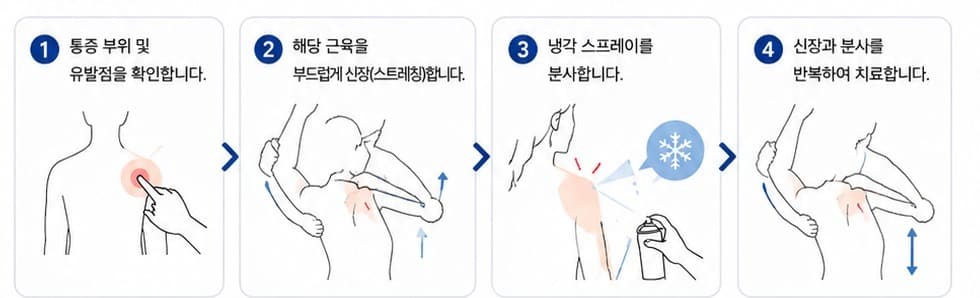 신장분사치료 4단계 — 유발점 확인, 근육 신장, 냉각 스프레이 분사, 신장과 분사 반복